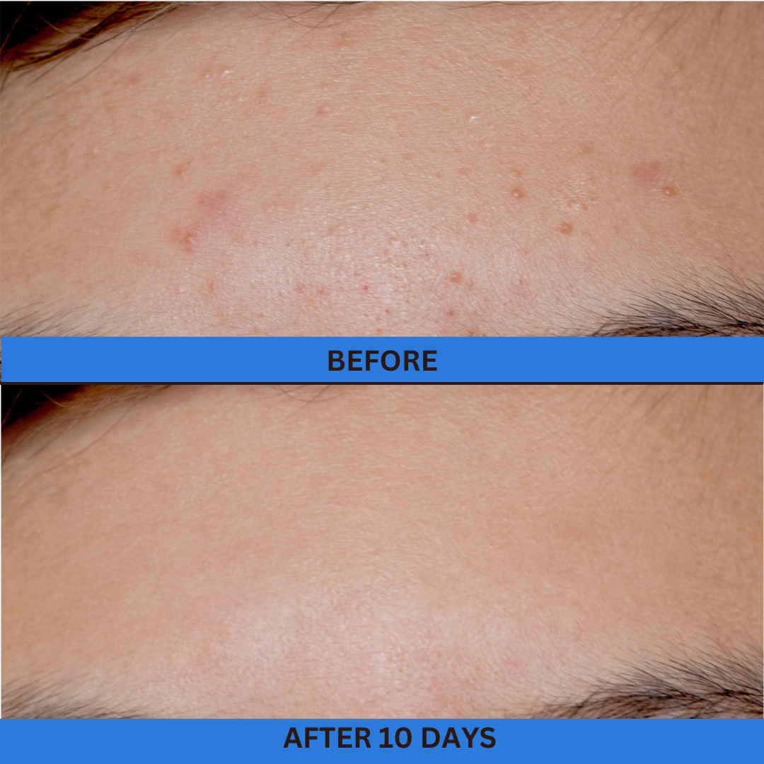 skin magic before and after forehead breakout blemishes and clogged pores