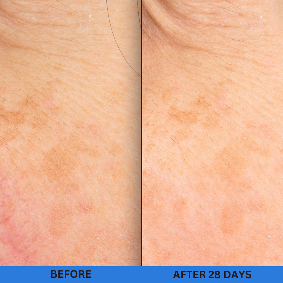 before and after discoloration hyperpigmentation and dark spots